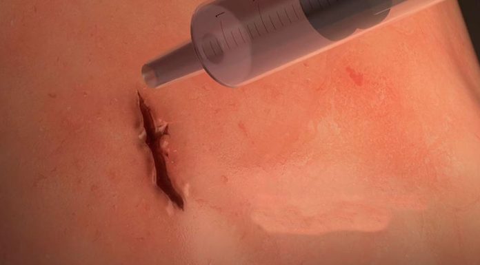 Pegamento quirúrgico, el futuro de la sutura