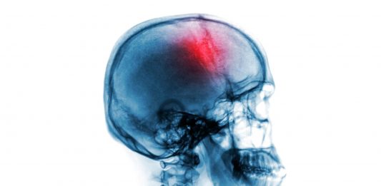 Enfermedades del cerebro. ¿Las conoces?