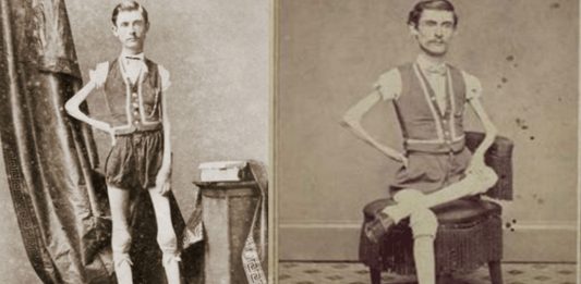 Isaac W. Sprague | El hombre al que llamaron el «esqueleto viviente» Isaac W. Sprague