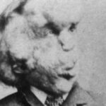 Síndrome de Proteus