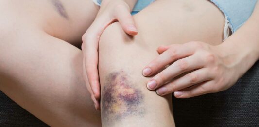 etapas de un moretón