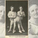 La triste historia de Rosa y Josepha Blazek, las siamesas de Bohemia