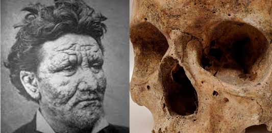 El supuesto origen de la Lepra es completamente inesperado | ¿Ardillas?