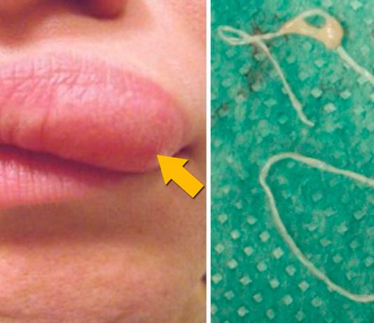 Ella tenía un misterioso bulto en el rostro… resultó ser algo inquietante Ella tenía un misterioso bulto en el rostro... resultó ser algo inquietante