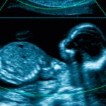 curiosidades de los fetus in fetu