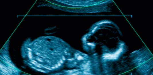 curiosidades de los fetus in fetu