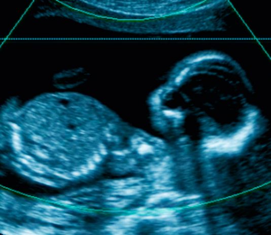 curiosidades de los fetus in fetu