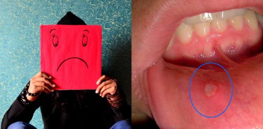 El porqué salen las aftas o "pupas" en la boca | 6 Causas