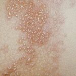 Varicela en adultos | 10 Curiosidades y por qué es tan grave