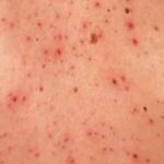 Varicela en adultos | 10 Curiosidades y por qué es tan grave