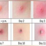 Varicela en adultos | 10 Curiosidades y por qué es tan grave