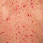 Varicela en adultos | 10 Curiosidades y por qué es tan grave