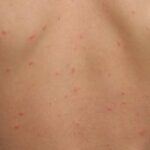 ¿Por qué pican los mosquitos? Descubre cómo evitarlo