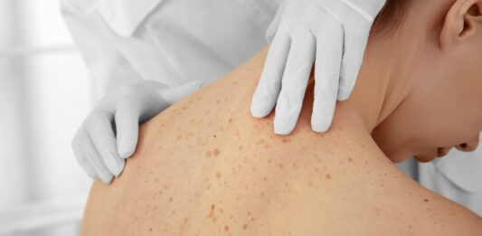 ¿Por qué tenemos lunares? | Qué son y cómo se forman Por qué tenemos lunares, Qué son y cómo se forman