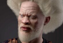 albinos famosos