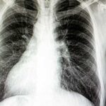 situs-inversus