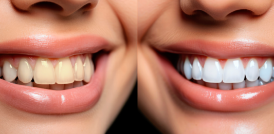 formas de blanquear los dientes